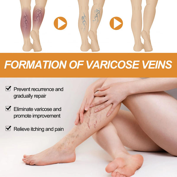 Varicose Vein Relief Spray – Natural Leg Pain & Swelling Relief