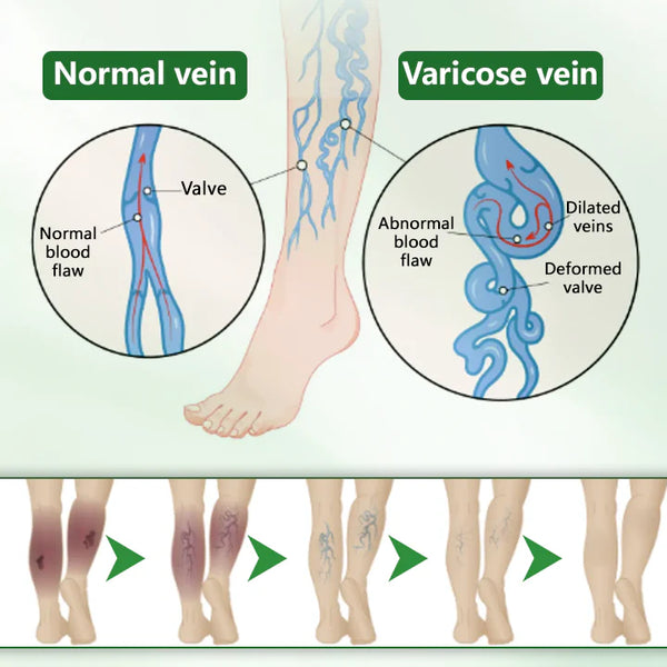 VeinFlex Magnesium Spray – Varicose Vein & Leg Pain Relief (FDA Certified)