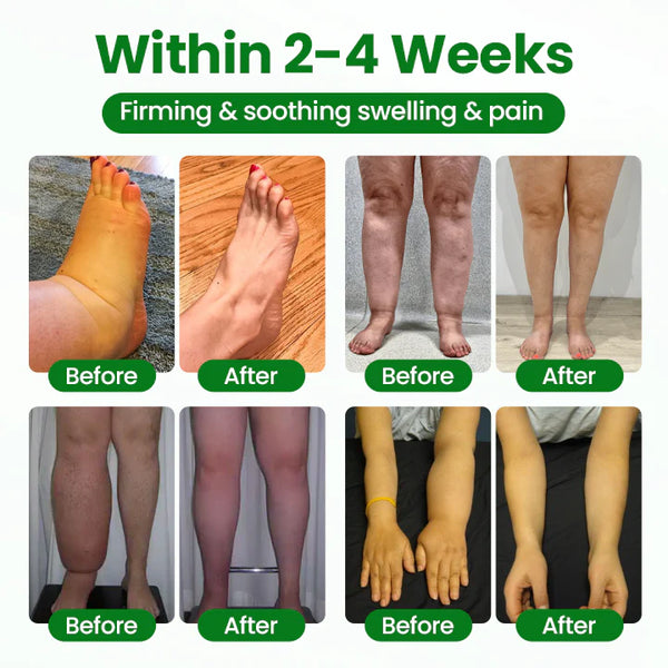 VeinFlex Magnesium Spray – Varicose Vein & Leg Pain Relief (FDA Certified)