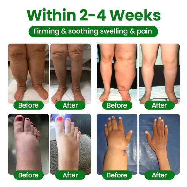 VeinFlex Magnesium Spray – Varicose Vein & Leg Pain Relief (FDA Certified)