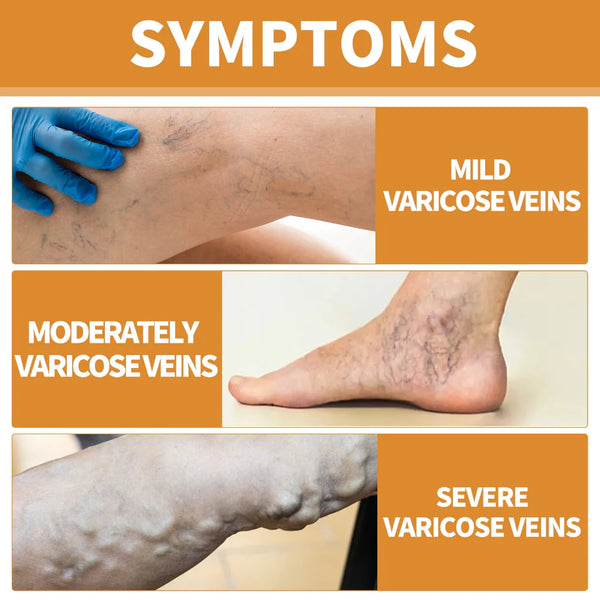 Varicose Vein Relief Spray – Natural Leg Pain & Swelling Relief