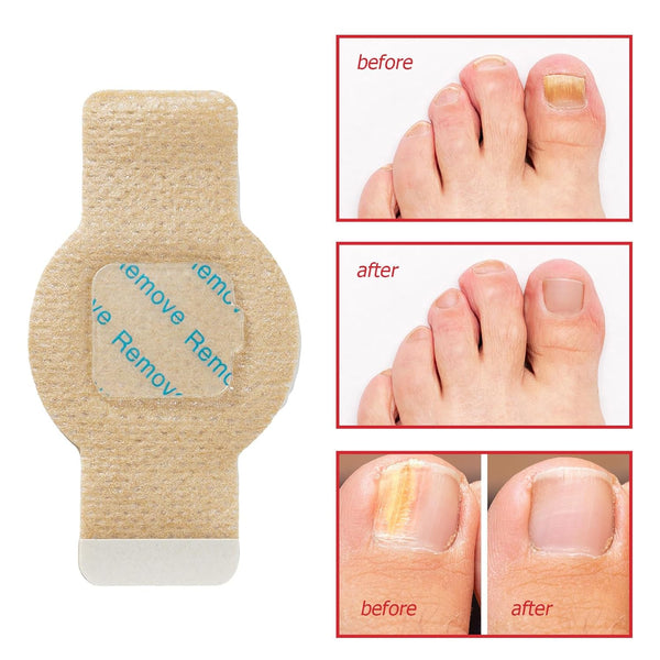 NailHeal Fungal Nail Patches – Anti-Fungal Treatment Strips