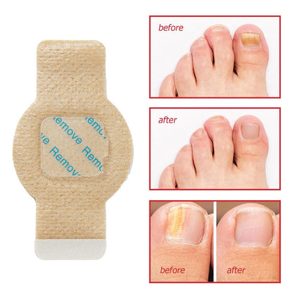 NailHeal Fungal Nail Patches – Anti-Fungal Treatment Strips
