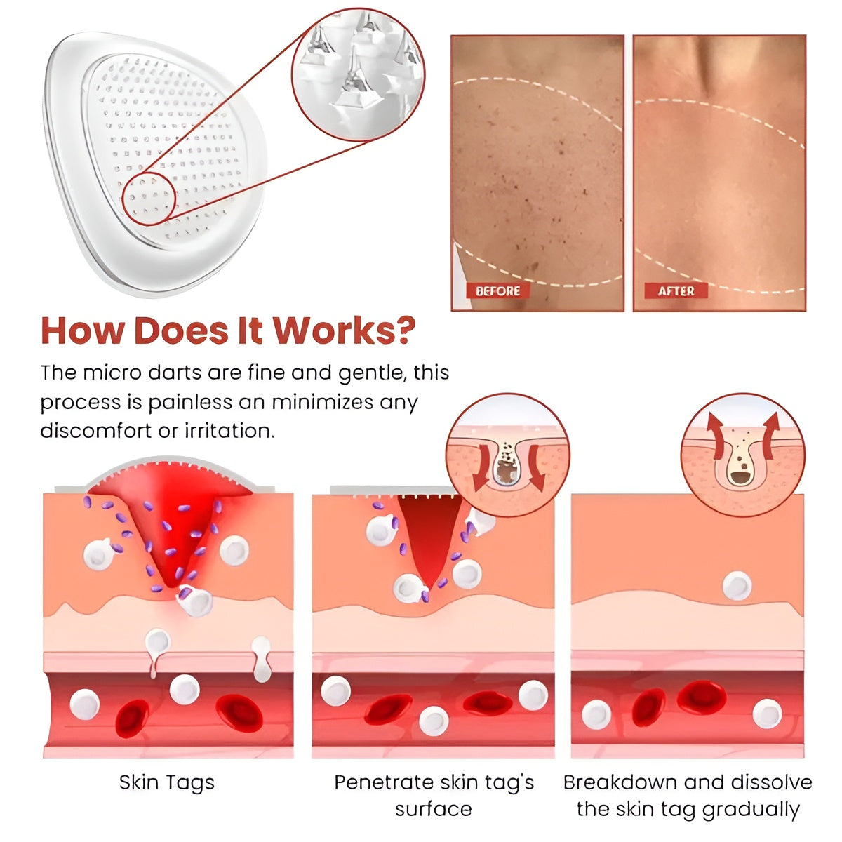 DermaSmooth Skin Tag & Acne Removal Patches – Fast Skin Treatment
